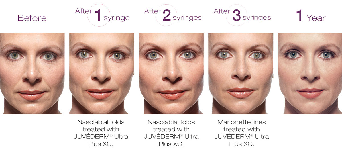 Botox and Juvederm skin rejuvenation services in Fort Worth with products from Allergan, Henry Schein and Galderma. 